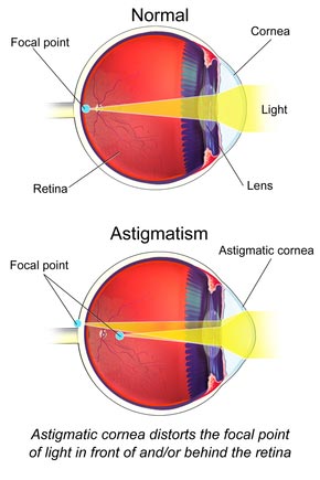 What Is Astigmatism?